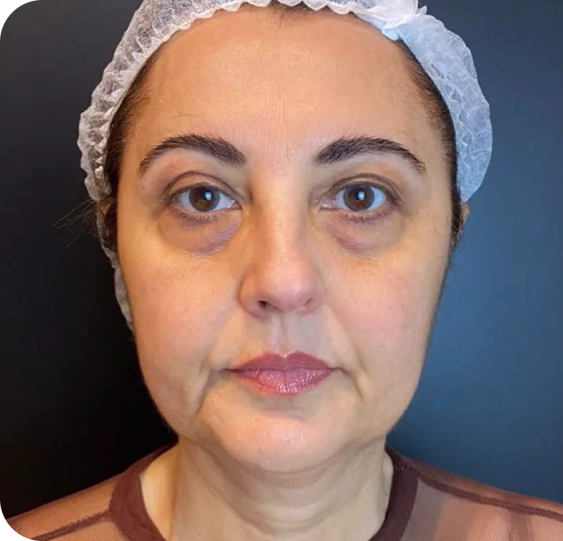 Rosto antes do Awake Facelift