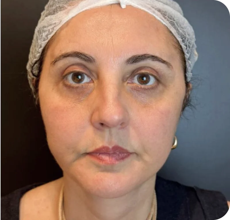 Resultado após o Awake Facelift